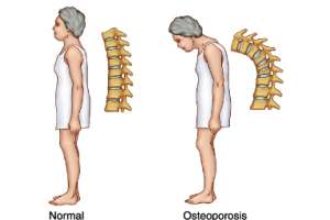 Imagen ilustrativa del artículo Prevenir la Osteoporosis con Alimentos Ricos en Calcio
